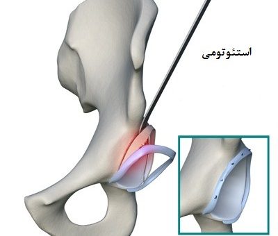 استئوتومی